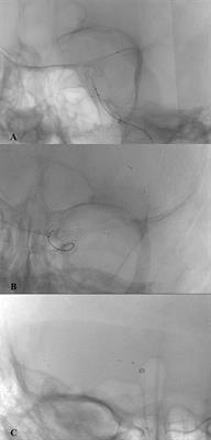 Mechanical thrombectomy of large vessel occlusion using adjustable vs. self-expanding stent-retriever—Comparison of Tigertriever device with stent-like stent-retrievers: A propensity score analysis